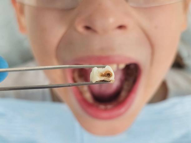 Best Emergency Dentist for Lost Fillings or Crowns in Hays, NC